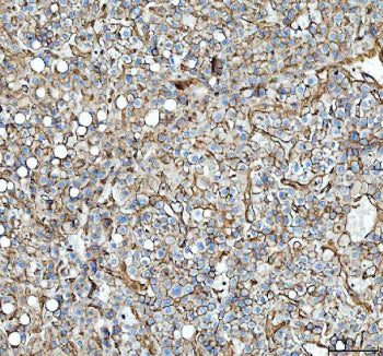 IHC staining of FFPE human liver cancer tissue with Annexin A2 antibody, HRP-secondary and DAB subst