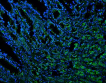 Immunofluorescent staining of FFPE human intestinal cancer with TXN2 antibody (green) and DAPI nucle