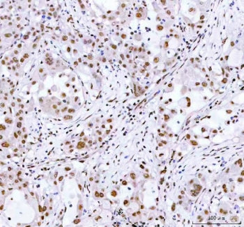 IHC staining of FFPE human lung cancer tissue with ARID domain-containing protein 1A antibody. HIER: