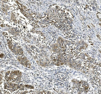 IHC staining of FFPE human lung cancer tissue with Cyclooxygenase 2 antibody. HIER: boil tissue sect