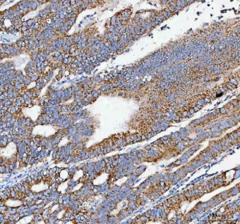 IHC staining of FFPE human rectum adenocarcinoma tissue with Pellino-3 antibody. HIER: boil tissue s