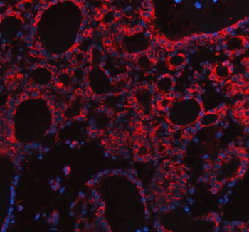 Immunofluorescent staining of FFPE human thyroid cancer tissue with SLC39A10 antibody (red) and DAPI