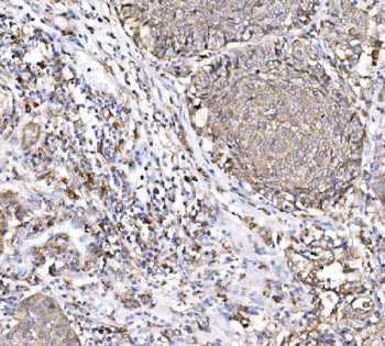 IHC staining of FFPE human lung cancer tissue with PAK1 antibody. HIER: boil tissue sections in pH8 