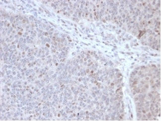 IHC staining of FFPE human lymphoma tissue with POLE3 antibody (clone PCRP-POLE3-2F10) at 2ug/ml. HI