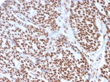 IHC staining of FFPE human breast carcinoma with Estrogen Receptor alpha antibody (clone ESR1/3557).