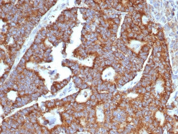 IHC staining of FFPE human hepatocellular carcinoma tissue with Transferrin antibody (clone TF/4797)