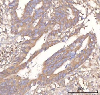 IHC staining of FFPE human rectum adenocarcinoma tissue with Neuralized-like protein 4 antibody. HIE