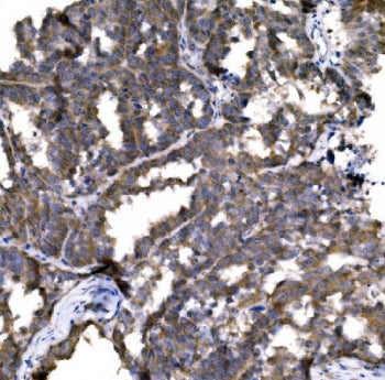 IHC staining of FFPE human ovarian cancer with CASP9 antibody. HIER: boil tissue sections in pH8 EDT