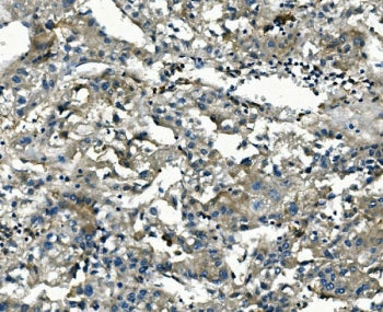 IHC staining of FFPE human liver cancer with AKR1D1 antibody. HIER: boil tissue sections in pH8 EDTA