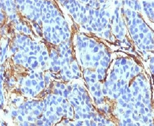 IHC testing of FFPE human melanoma with CD271 antibody.