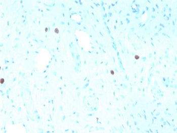 IHC staining of FFPE human cervix with recombinant HPV16 L1 antibody (clone rHPV16L1/1058). Required