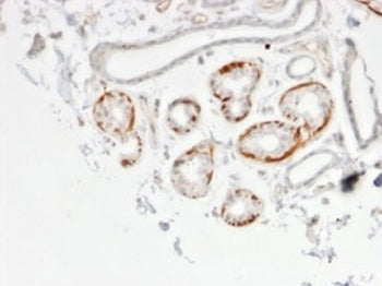 IHC staining of FFPE human breast carcinoma tissue with GTF2H2C antibody (clone PCRP-GTF2H2C-2C9). H