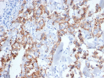 IHC staining of FFPE human breast carcinoma tissue stained with ErbB2 antibody (clone ERBB2/6637) at