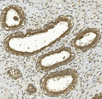 IHC staining of FFPE human breast cancer with NRF-2 antibody. HIER: boil tissue sections in pH8 EDTA