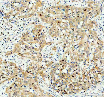 Immunohistochemical staining of SRARP using anti-SRARP antibody. SRARP was detected in a paraffin-em