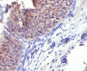 IHC testing of FFPE human bladder carcinoma and Keratin 10 antibody. Staining of formalin-fixed tiss