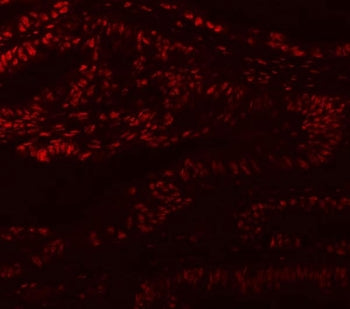 Immunofluorescent staining of FFPE human colon cancer with Muscleblind-like 1 antibody. HIER: steam 