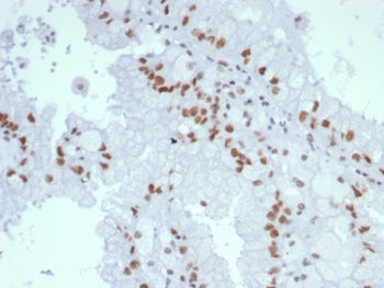 IHC staining of FFPE human renal cell carcinoma tissue with MutL Homolog 1 antibody (clone MLH1/7560