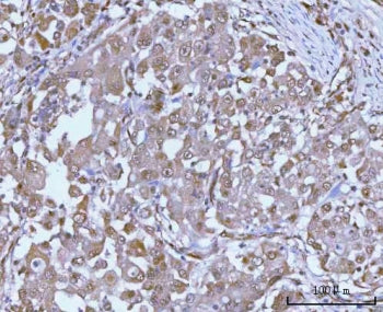 IHC staining of FFPE human lung adenocarcinoma tissue with PSMC4 antibody. HIER: boil tissue section