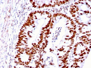 IHC staining of FFPE human colon carcinoma with MSH6 antibody. HIER: boil tissue sections in pH 9 10