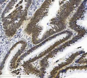 IHC staining of FFPE human low-differentiated adenocarcinoma with SMAD2 antibody. HIER: boil tissue 