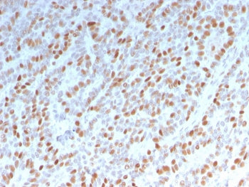 IHC staining of FFPE human breast carcinoma with Estrogen Receptor alpha antibody (clone ESR1/3342).