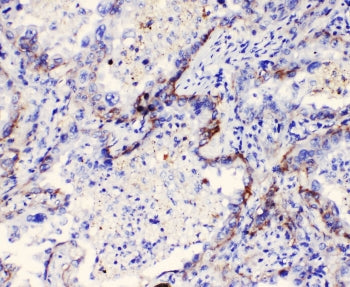 IHC staining of FFPE human lung cancer with ITGA3 antibody at 1ug/ml. HIER: boil tissue sections in 