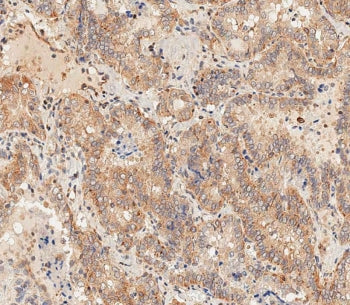 IHC testing of FFPE human thyroid carcinoma tissue with DLL3 antibody. HIER: steam section in pH6 ci