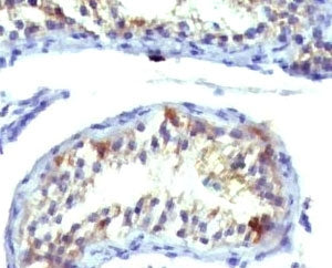 IHC analysis of Prolactin receptor antibody (clone ERSV8-1) and testicular carcinoma. Required HIER: