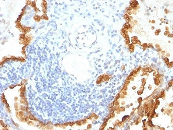 IHC: Formalin-fixed, paraffin-embedded human lung carcinoma stained with Cytokeratin 8/18 antibody (