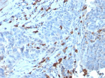 IHC staining of FFPE human tumor with recombinant IgM antibody (clone IGHM/3135R). HIER: boil tissue