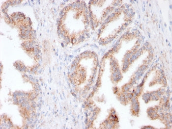 IHC testing of FFPE human prostate cancer with recombinant FOLH1 antibody (clone FOLH1/3149R). HIER: