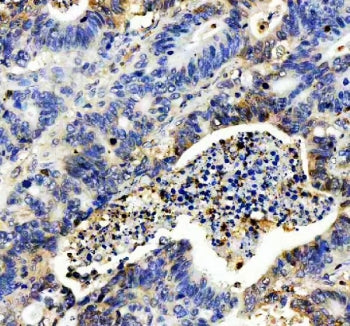IHC staining of FFPE human stomach cancer tissue with IL-8 antibody. HIER: boil tissue sections in p