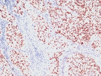 IHC: Formalin-fixed, paraffin-embedded human lung carcinoma stained with NKX2.1 antibody (clone SPM1