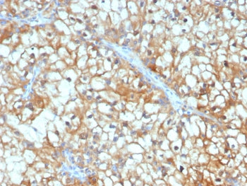 IHC staining of FFPE human renal cell carcinoma tissue with TGF beta 3 antibody (clone TGFB3/4801). 