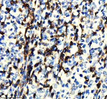 IHC staining of FFPE human lymphoma tissue with CD247 antibody, HRP-secondary and DAB substrate. HIE