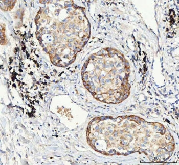 IHC testing of FFPE human lung cancer tissue with M6PR antibody. Required HIER: steam section in pH8