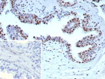 IHC staining of FFPE human prostate carcinoma tissue with recombinant AR-V7 antibody (clone DHTR/911
