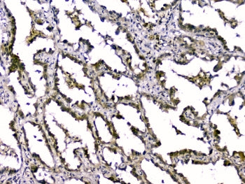 IHC staining of FFPE human lung cancer with TGFB2 antibody. HIER: boil tissue sections in pH6, 10mM 