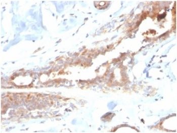 IHC staining of FFPE human breast carcinoma tissue with Lactoferrin antibody (clone LTF/4082). HIER: