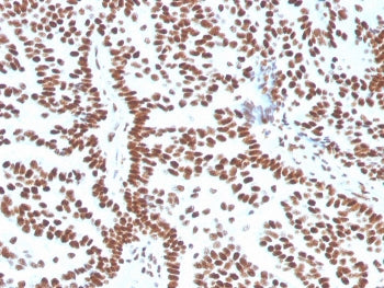 IHC staining of FFPE human breast carcinoma with Estrogen Receptor alpha antibody (clone ESR1/3556).