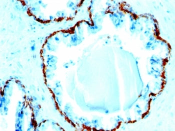 IHC: Formalin-fixed, paraffin-embedded human prostate carcinoma stained with Basic Cytokeratin antib
