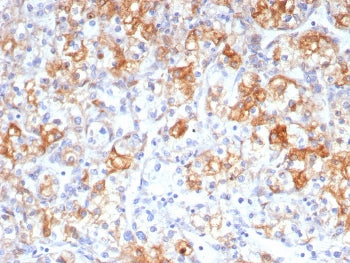 IHC staining of FFPE human renal cell carcinoma tissue with COX2 antibody (clone rCOX2/6996). HIER: 