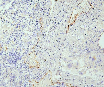 IHC staining of FFPE human lung cancer with eNOS antibody. HIER: boil tissue sections in pH6, 10mM c