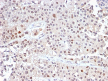 IHC staining of FFPE human urothelial carcinoma with recombinant p21 antibody (clone CIP1/2489R). HI