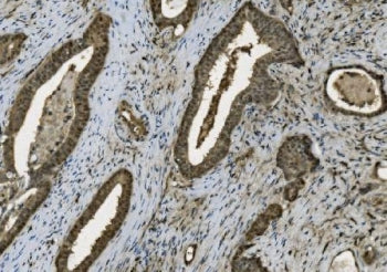 IHC staining of FFPE human gallbladder adenocarcinoma with Poly (ADP-ribose) polymerase 1 antibody. 