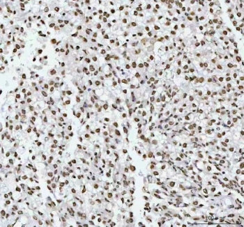 IHC staining of FFPE human testicular germ cell tumor tissue with RNA-binding motif protein 3 antibo