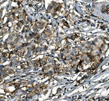 IHC staining of FFPE human breast cancer with SGK1 antibody. HIER: boil tissue sections in pH8 EDTA 