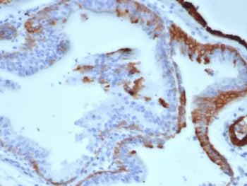 IHC staining of FFPE human prostate carcinoma tissue with Cytokeratin 14 antibody (clone KRT14/6956)