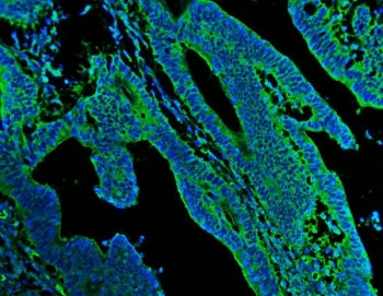 Immunofluorescent staining of FFPE human colon cancer with N-Cadherin antibody (green) and DAPI nucl